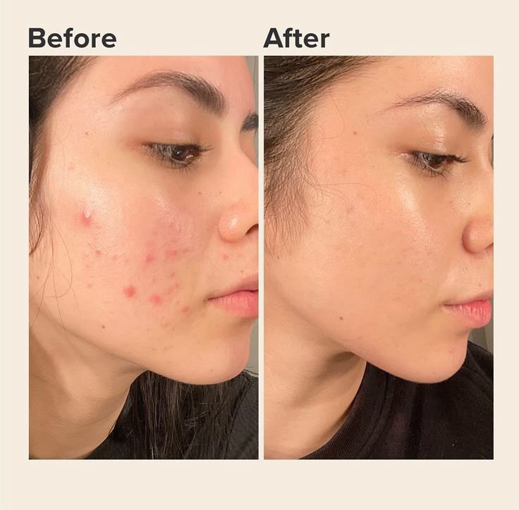 Best Acne Face Wash in Pakistan 2026 — Why Mad Chemist Is the Clear Winner