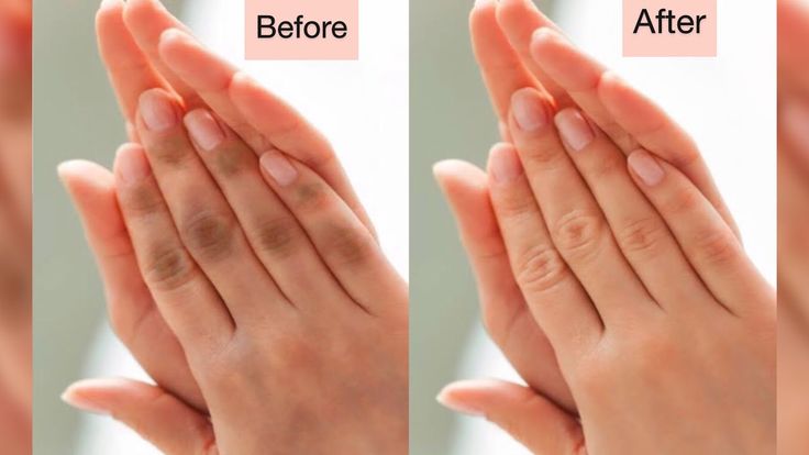 Dark Knuckles: Simple Causes, Treatment & Easy Skincare Tips