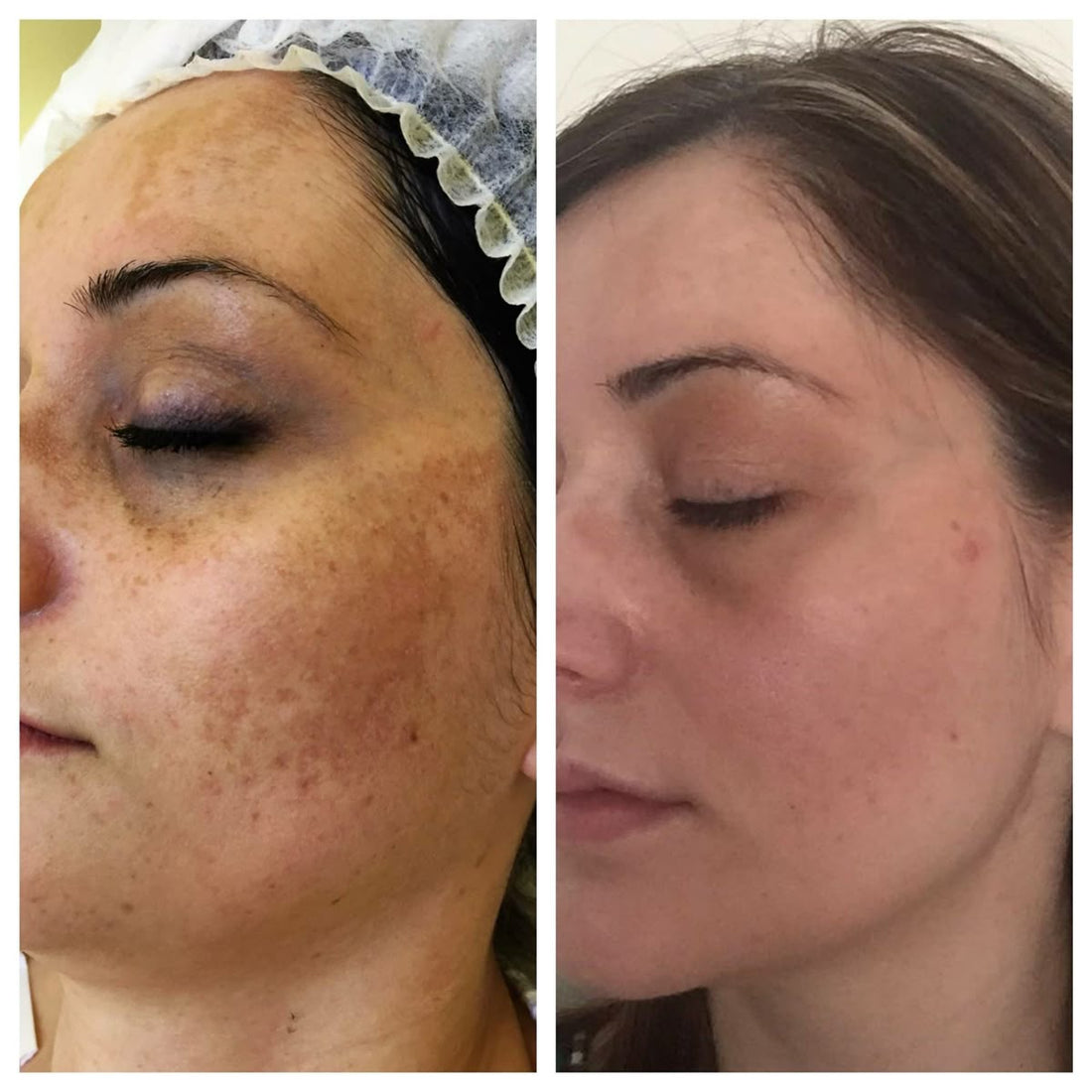 Glycolic Acid